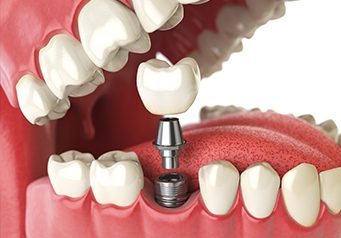 Advantages and disadvantages of Dental Implants