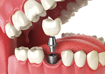 Dental Implants: advantages and disadvantages | Pacific Periodontics &amp; Implants