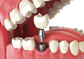 Advantages and disadvantages of Dental Implants