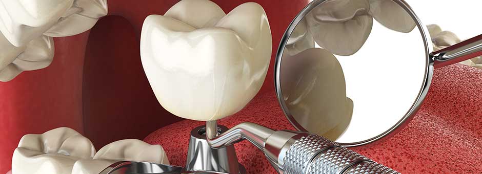 The History of Dental Implants