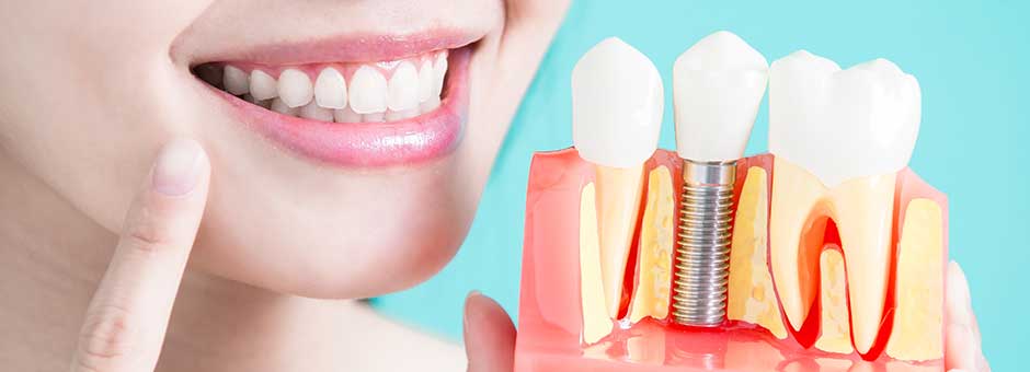 What Is The Future of Dental Implants